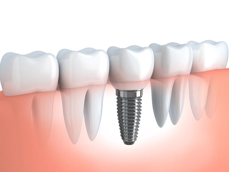 Dental Implants Spokane Valley, WA
